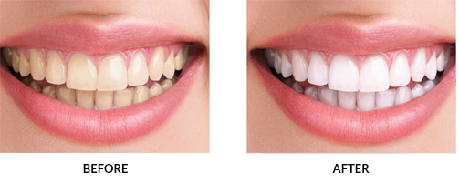 Teeth Whitening | Dentist in Carina | Carina Dental Clinic