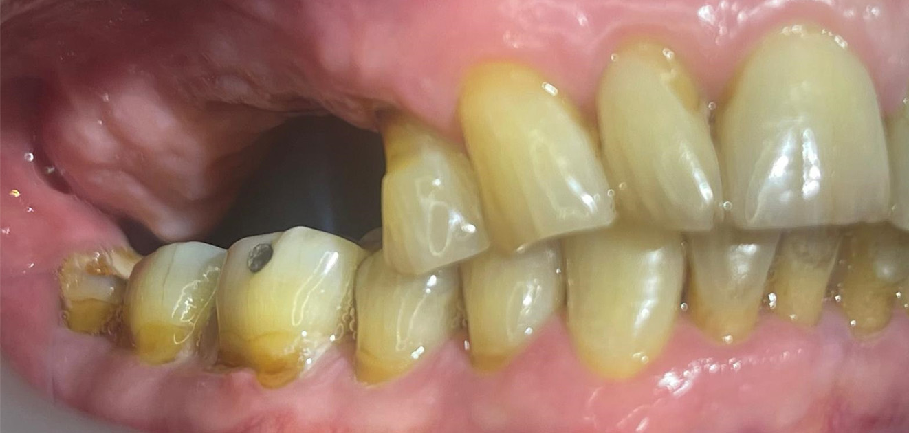 Dental Implant Before