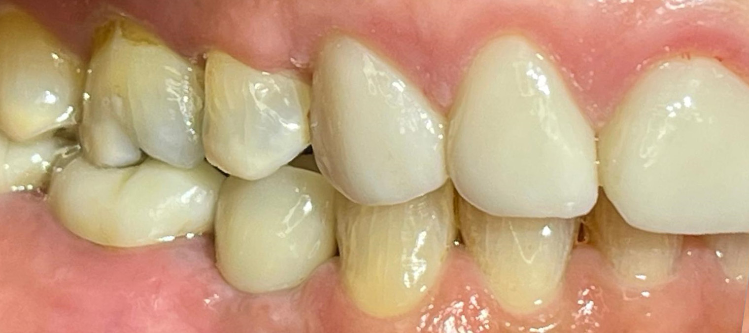 Implants-After