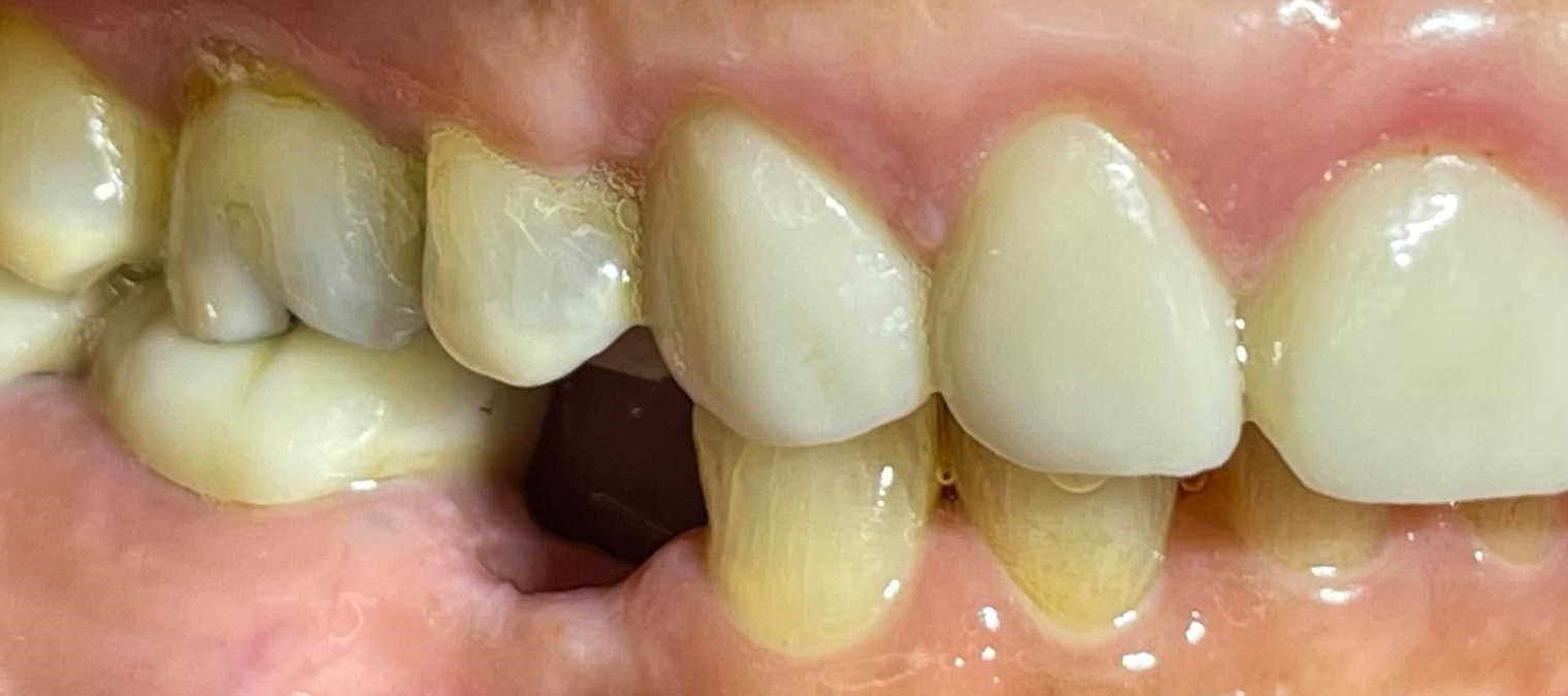 Implants-Before