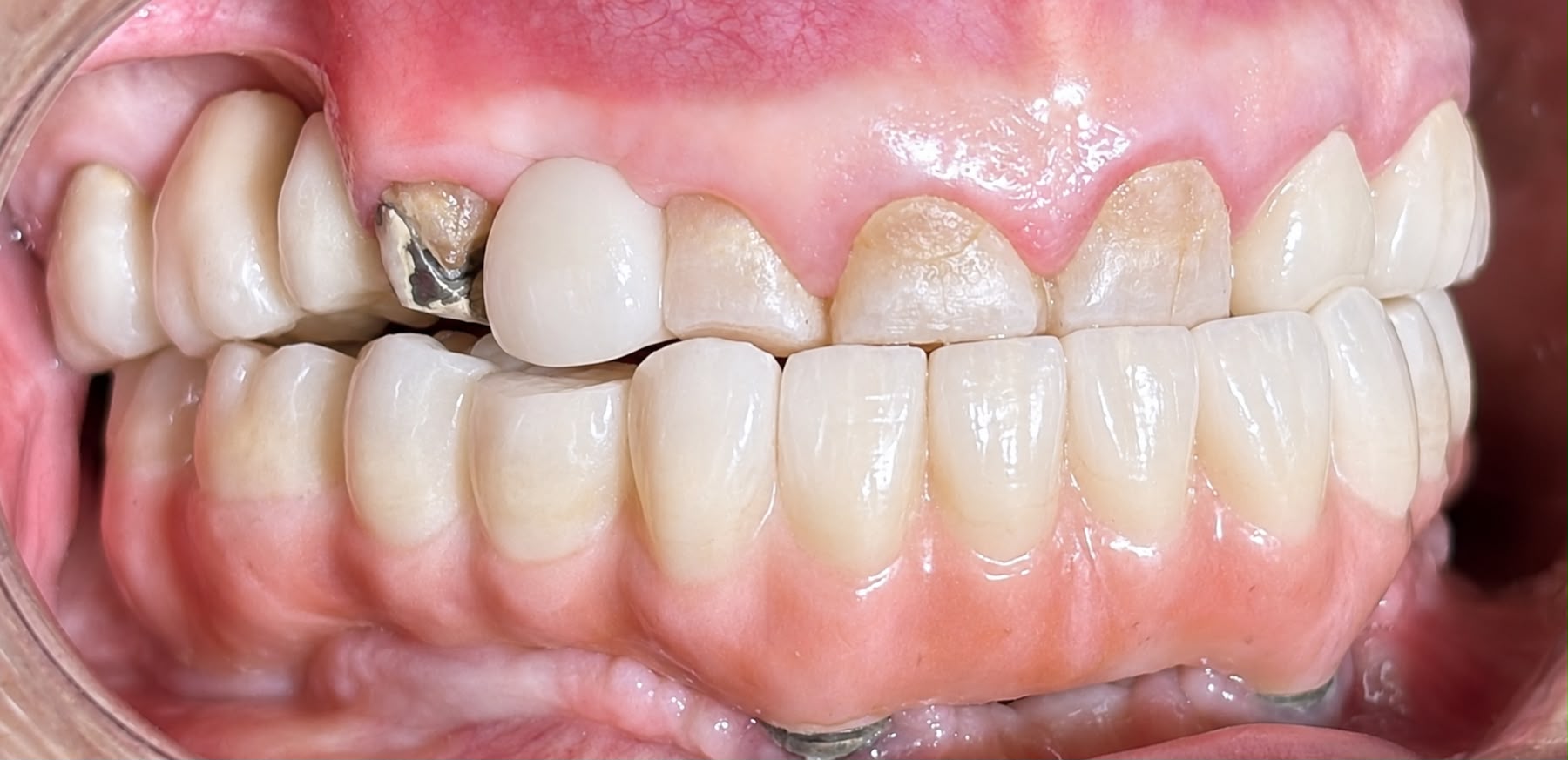 after implant - aug 2026