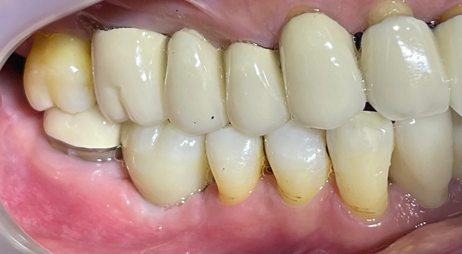 after_dental_implant_15May