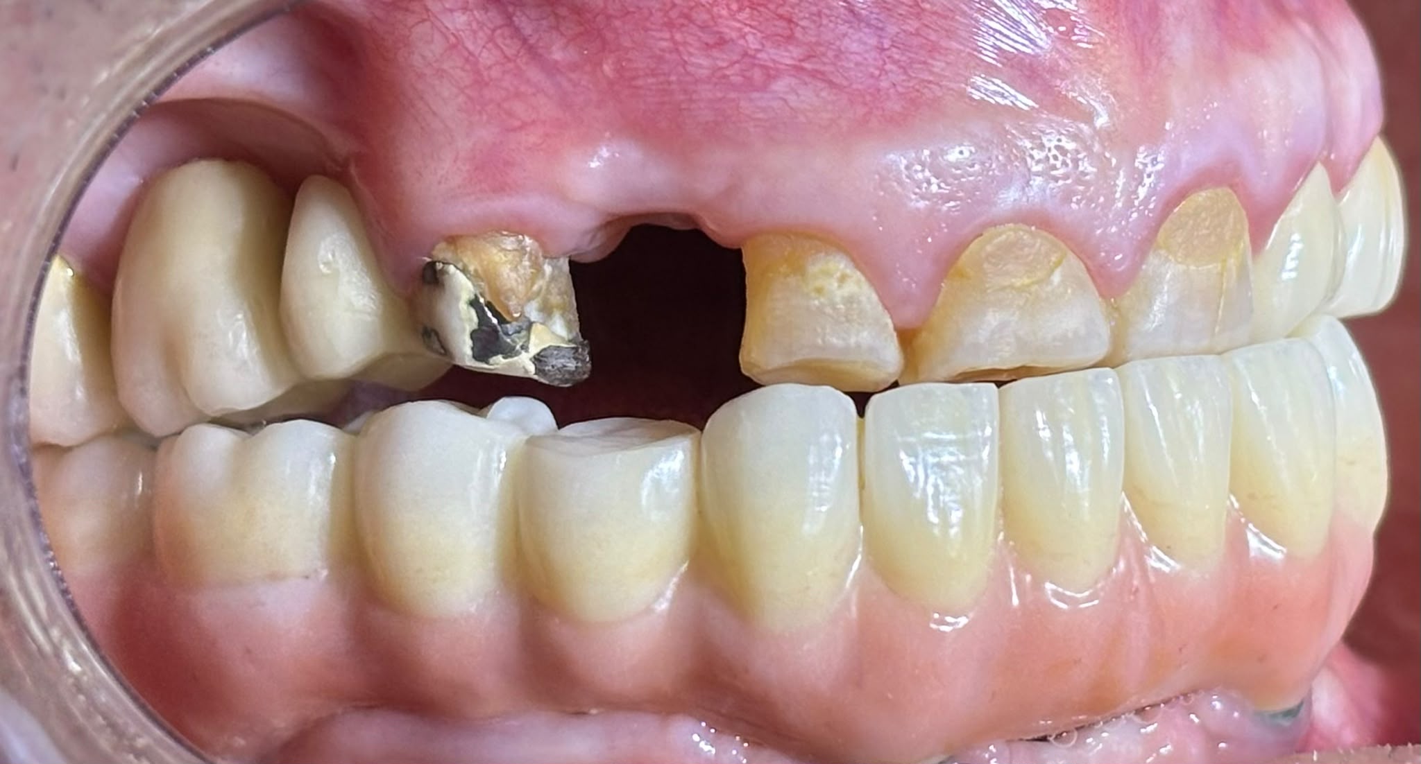 before implant - aug 2026