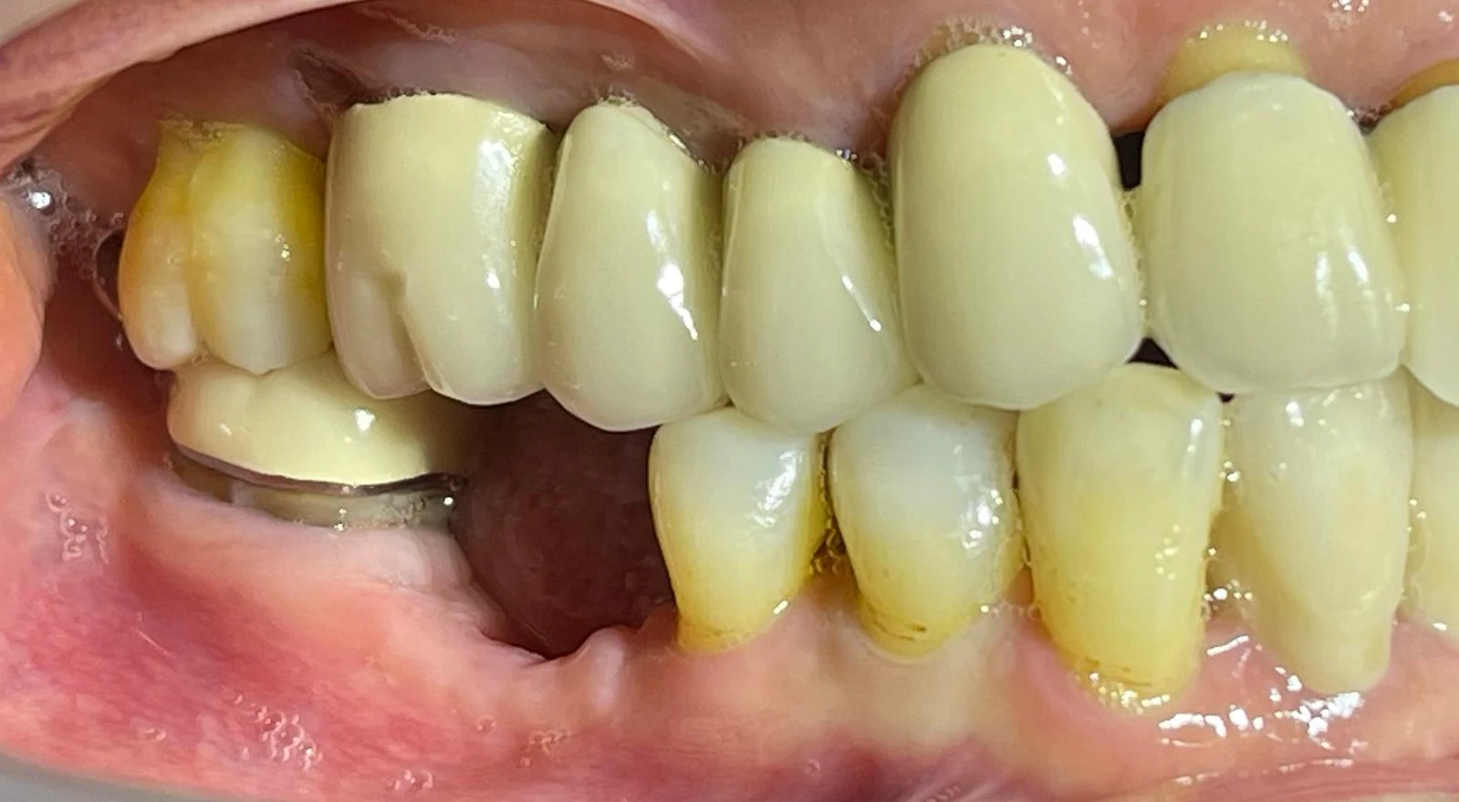 before_dental_implant_15thMay
