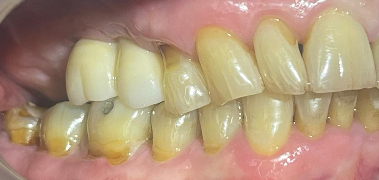 dental-implant-after-21
