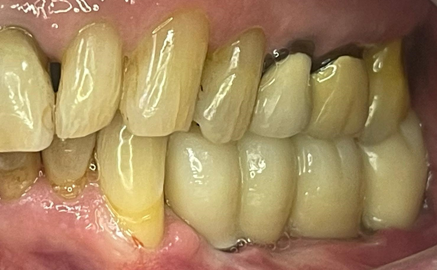 dental-implant-after-31