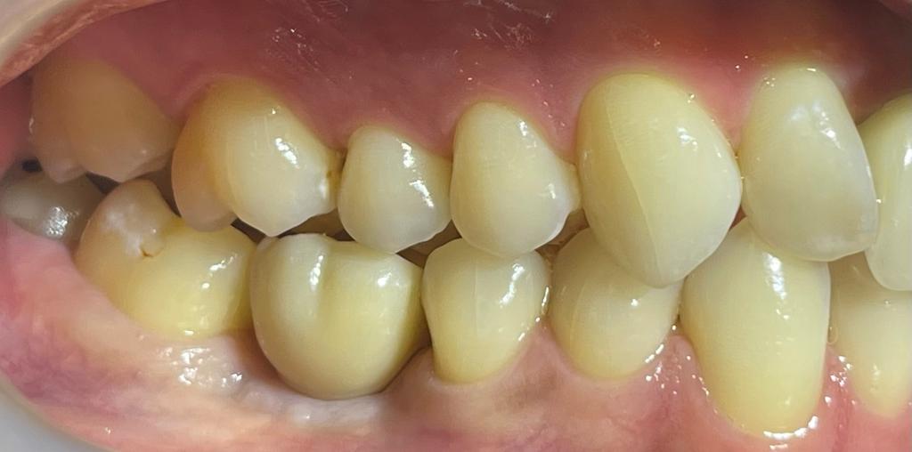 dental-implant-after