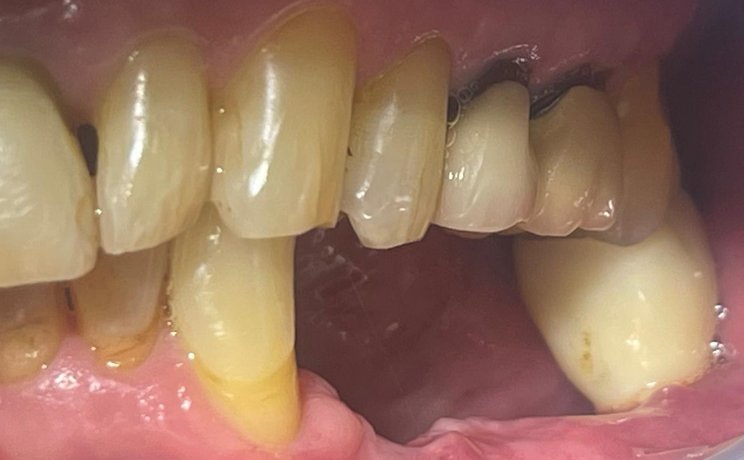 dental-implant-before-31