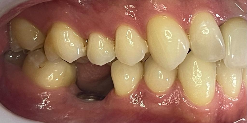 dental-implant-before