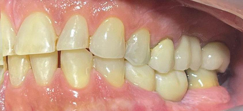 implant-after-1