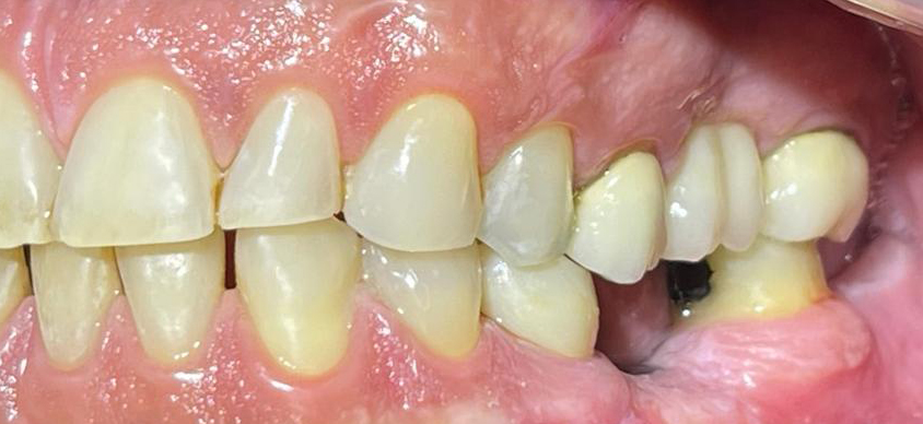 implant-before-1