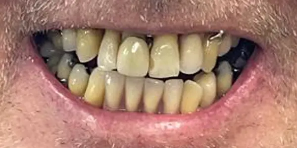 01-dentures-after