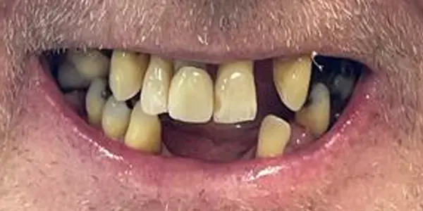 01-dentures-before