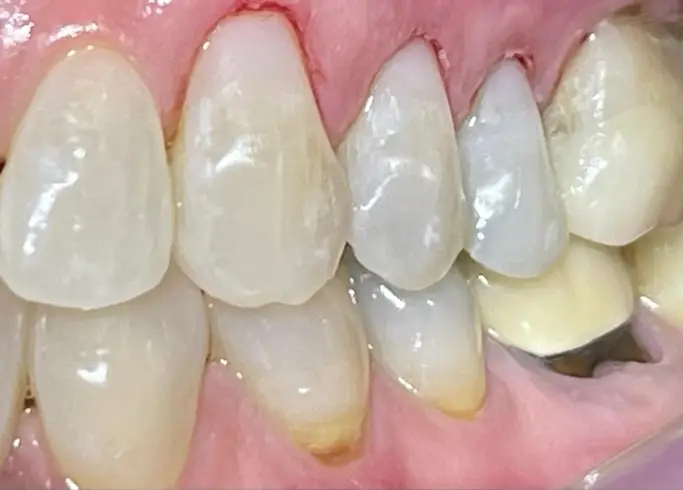 01-fillings-after