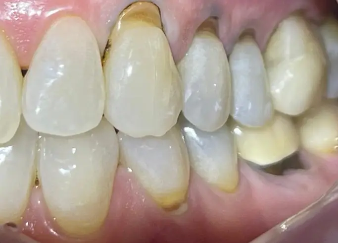 01-fillings-before