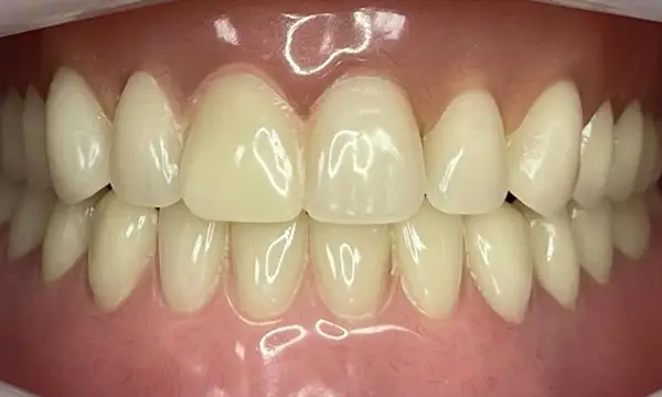 01-implant-retained-denture-after