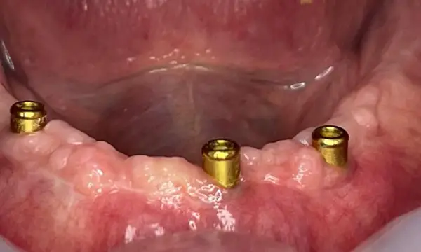 01-implant-retained-denture-before