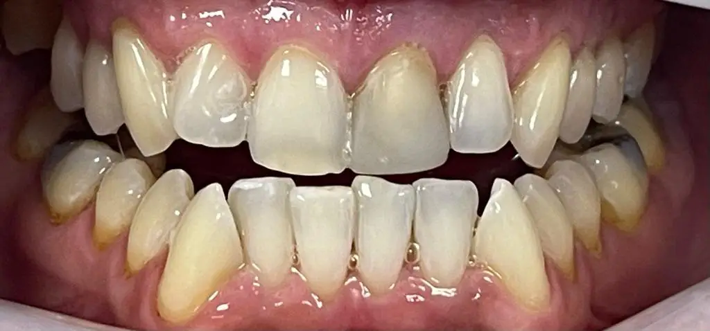 01-teeth-whitening-after