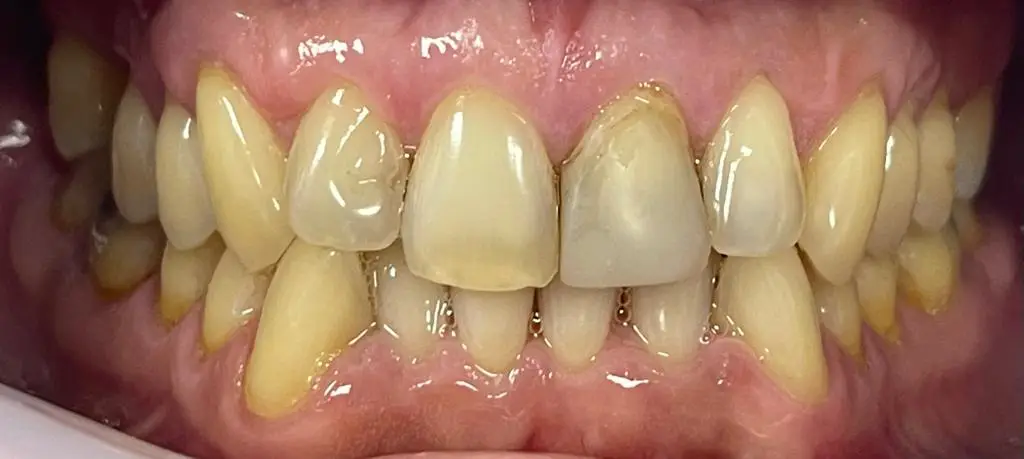 01-teeth-whitening-before