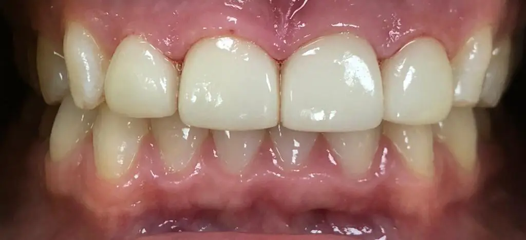 01-veneers-after