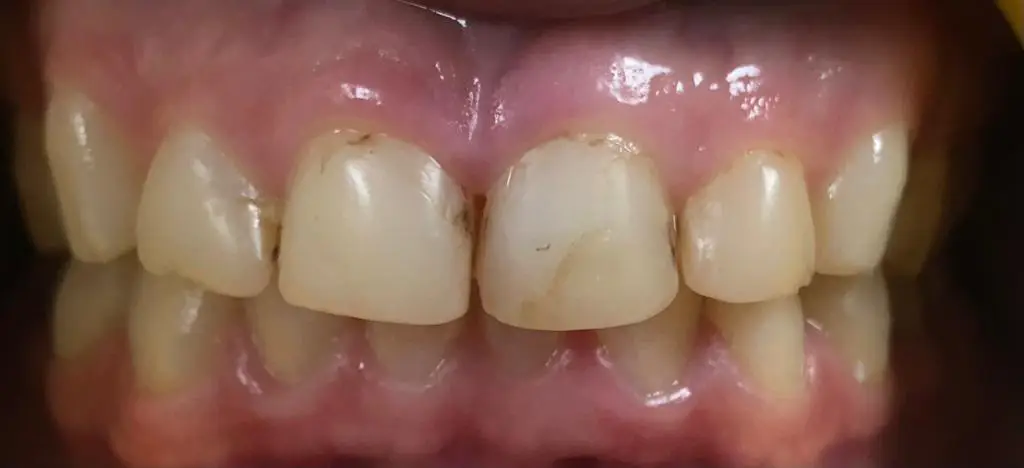01-veneers-before