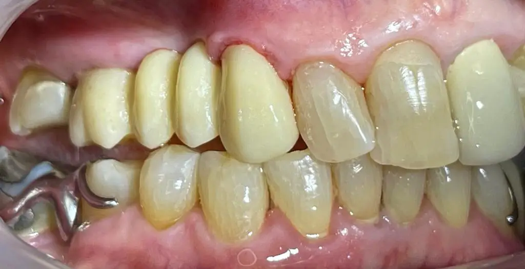 02-dental-bridge-after
