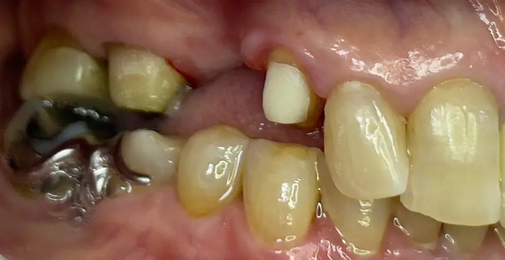 02-dental-bridge-before