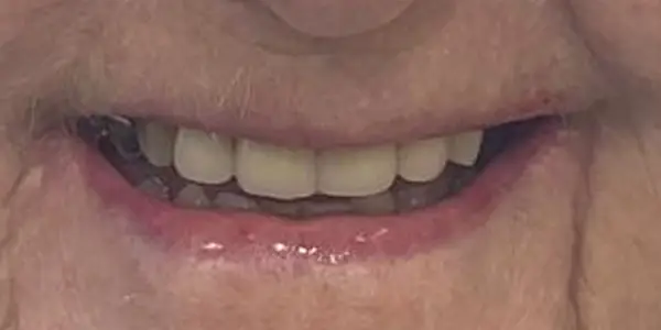 02-dentures-after