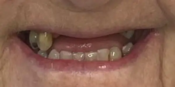 02-dentures-before