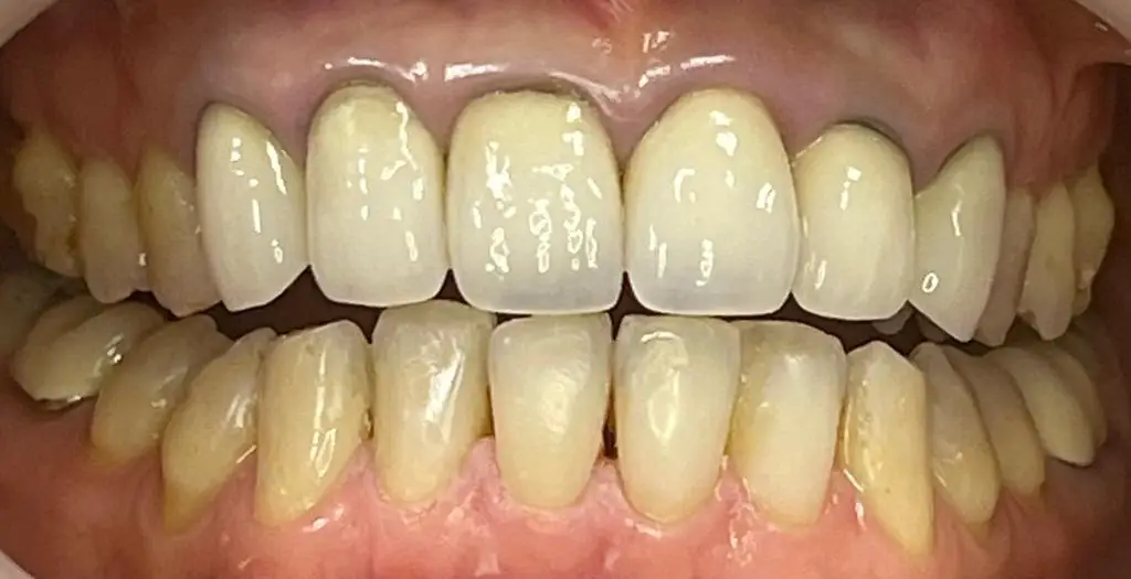 02-fillings-after