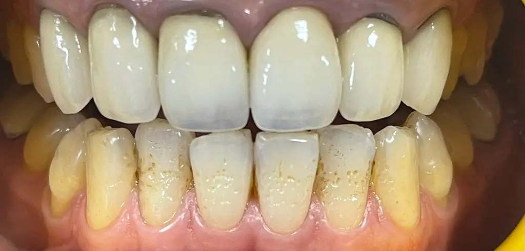 02-fillings-before