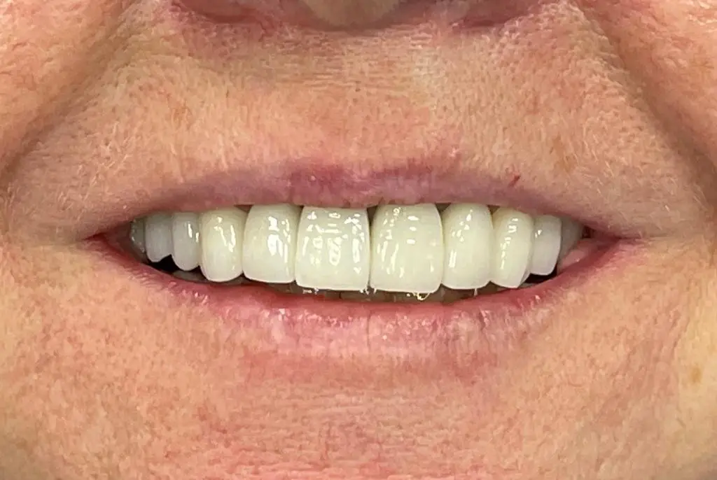 02-full-mouth-rehabilitation-after