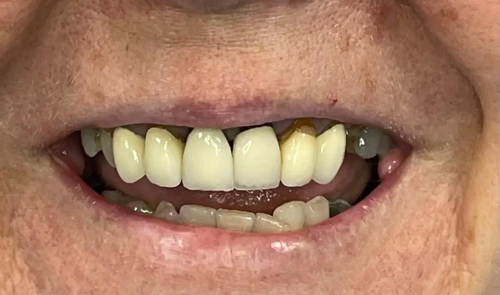 02-full-mouth-rehabilitation-before
