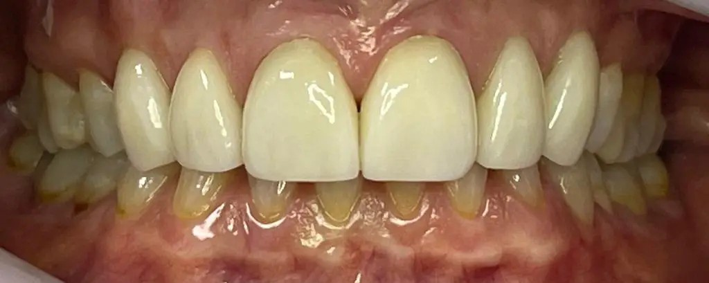 02-veneers-after