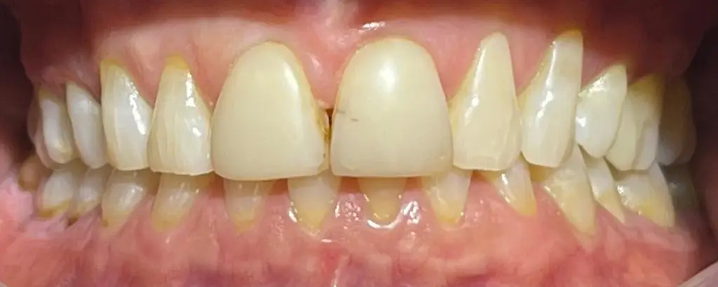 02-veneers-before