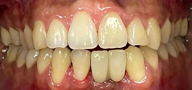 03-dental-bridge--after