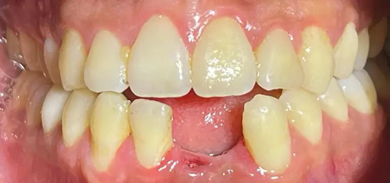 03-dental-bridge-before