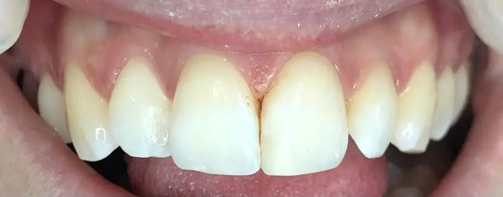 03-fillings-after