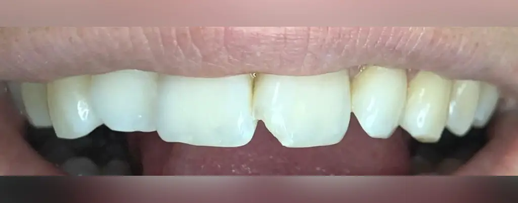 03-fillings-before