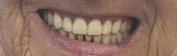 03-implant-retained-denture-after