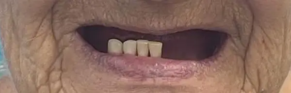 03-implant-retained-denture-before