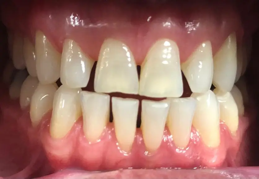 03-veneers-before