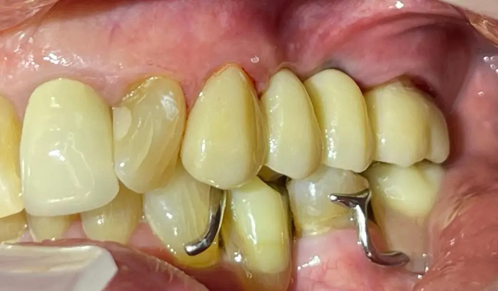 04-dental-bridge-after