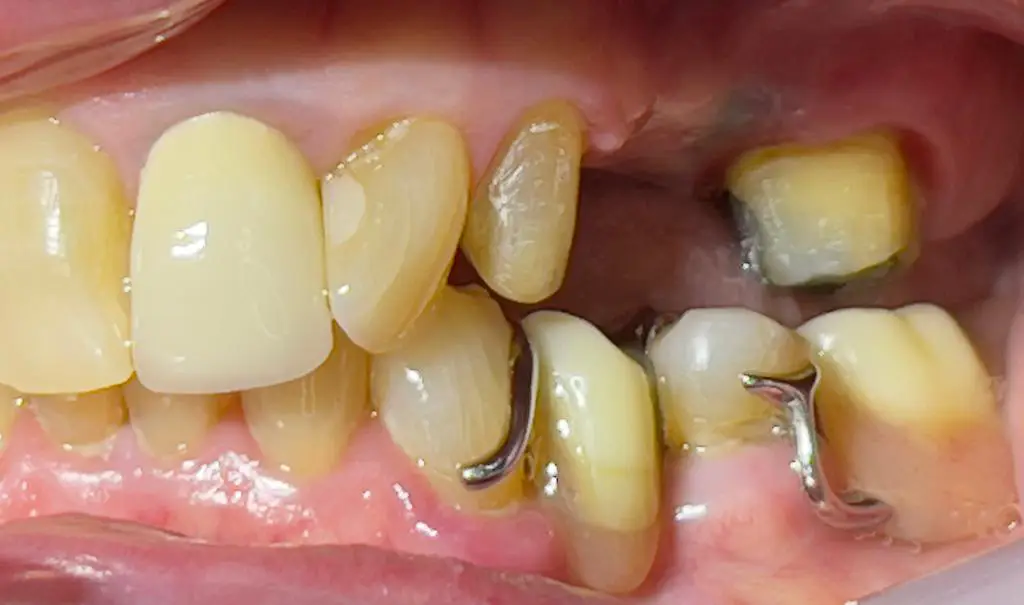 04-dental-bridge-before