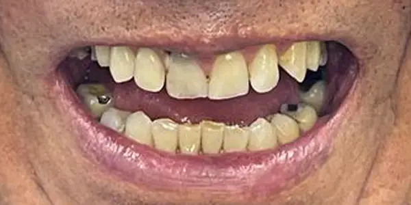 04-dentures-after