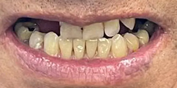 04-dentures-before