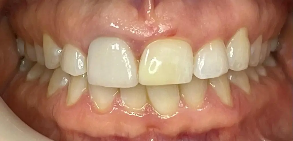 04-fillings-after