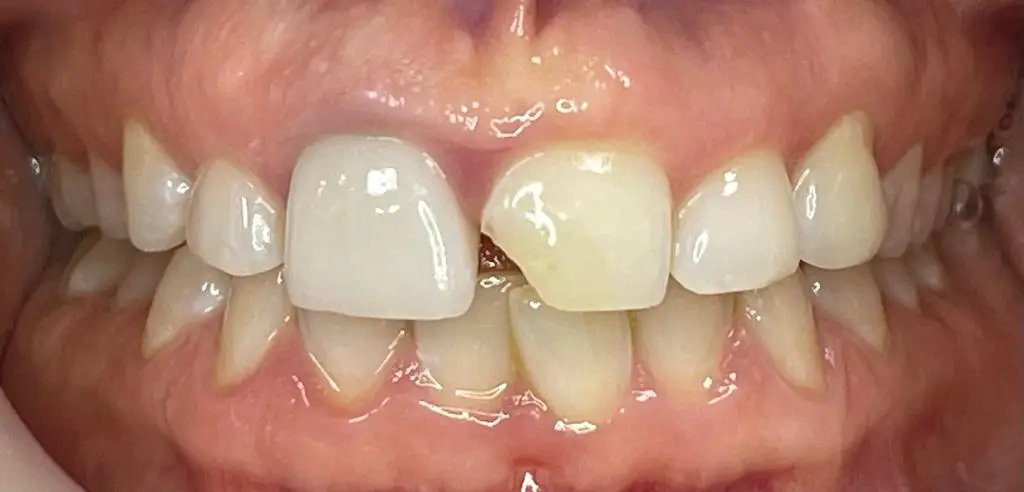 04-fillings-before
