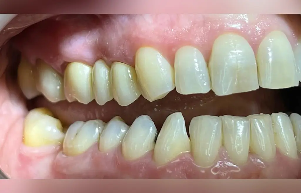 05-dental-bridge-after