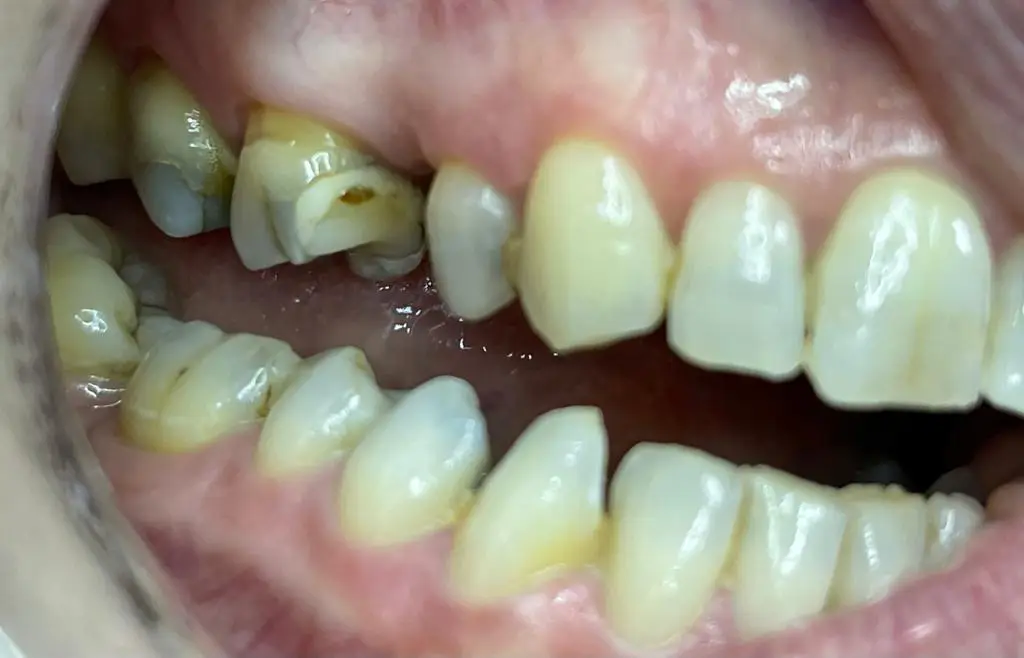 05-dental-bridge-before